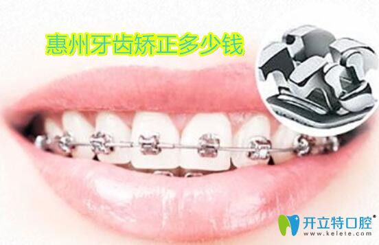 惠州帶牙套多少錢?內(nèi)附隱形和鋼絲牙齒矯正價格及醫(yī)院名單