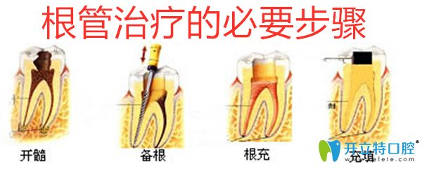 根管治療必要步驟 根管治療必要步驟