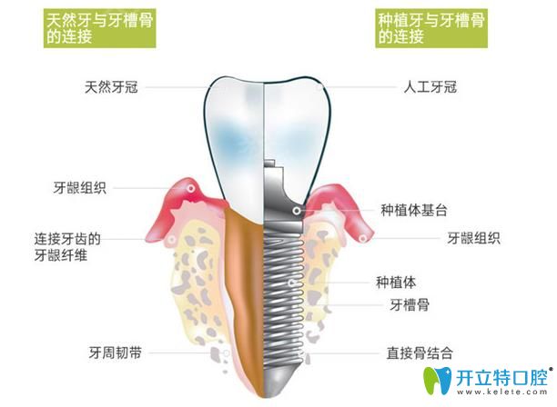 生物活性種植牙