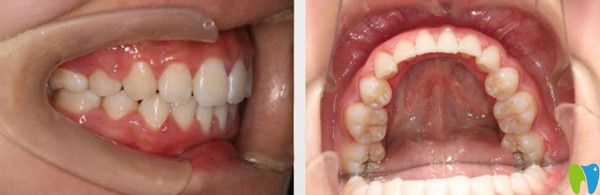 成都圣貝牙科正畸如何？附網友整牙的感受及圣貝箍牙價格