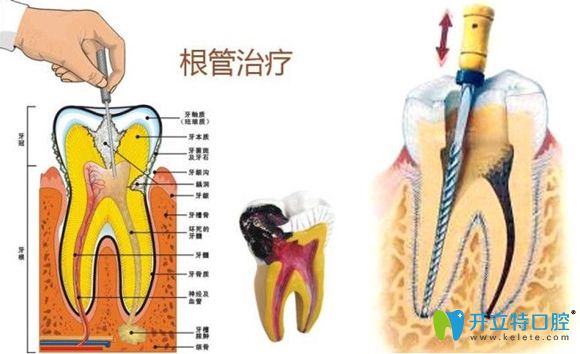 根管治療的介紹和過程圖