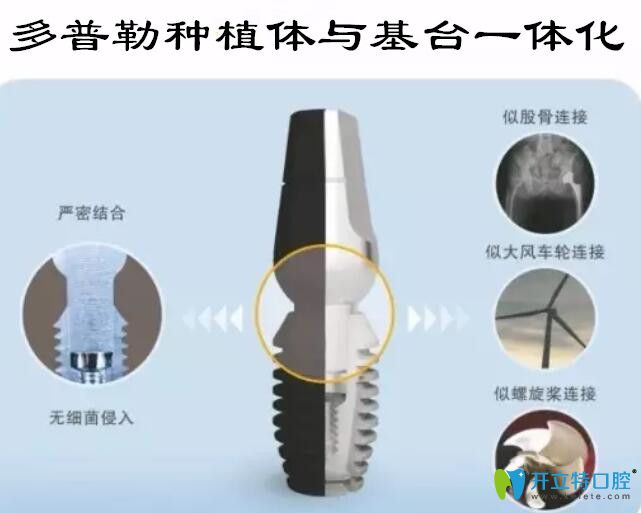 韓國(guó)多普勒種植牙優(yōu)勢(shì)