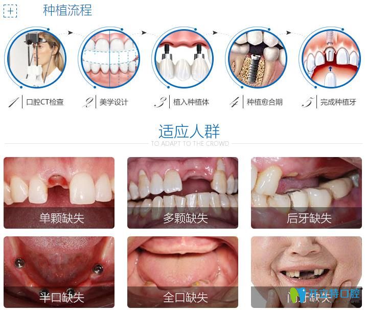 種植牙的流程與適應人群