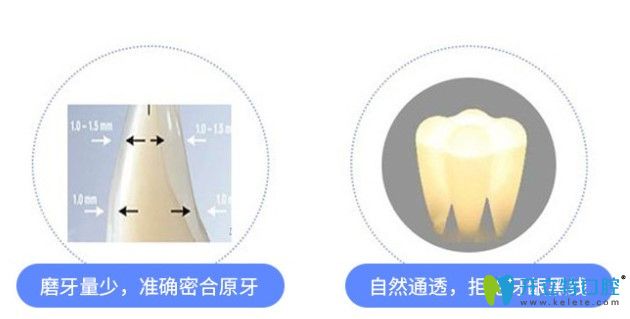 國(guó)產(chǎn)全瓷牙好還是進(jìn)口好