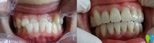 28歲矯正牙齒前后照片