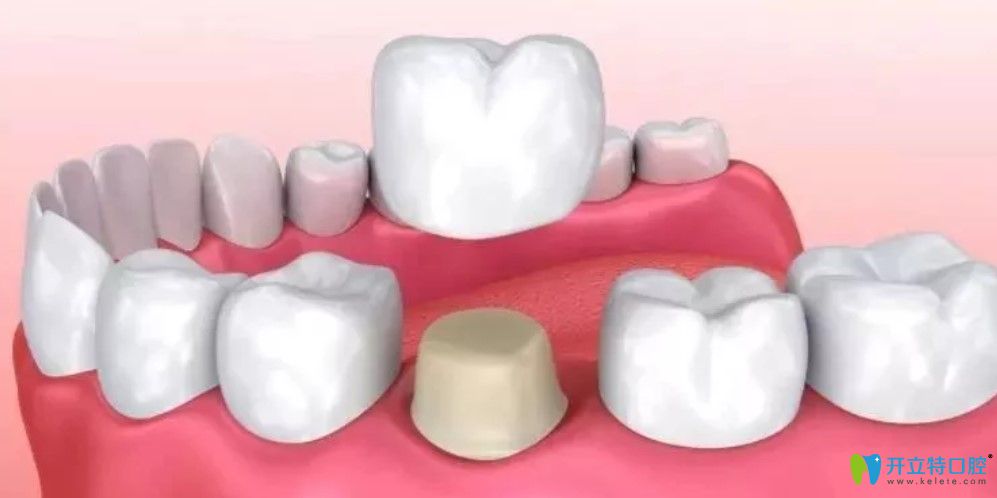 全瓷牙和烤瓷牙哪個好