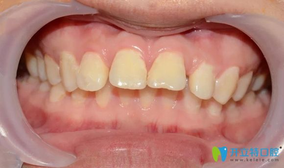 我在北京美萊口腔做矯正前的牙齒圖
