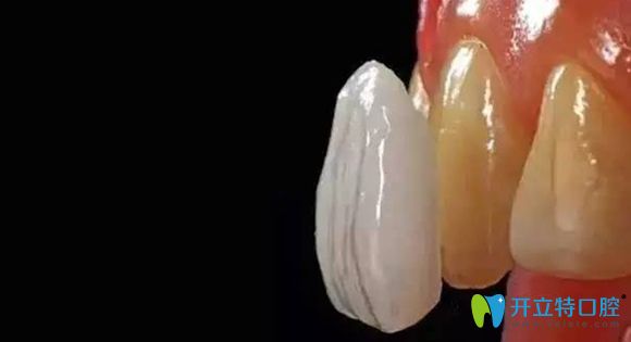 牙齒貼面修復為現(xiàn)在色素牙或缺損牙修復的較好方法