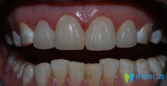 樹脂牙齒貼面修復效果圖