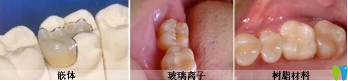 惠州哪里補牙好又便宜,參考牙科比較靠譜的口腔名單及價格