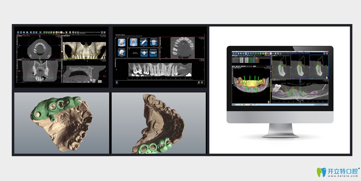 數(shù)字化種植牙