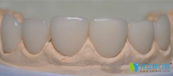 聚合瓷貼面修復效果圖展示