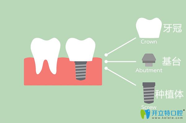 完整的種植牙由牙冠 基臺 種植體合成