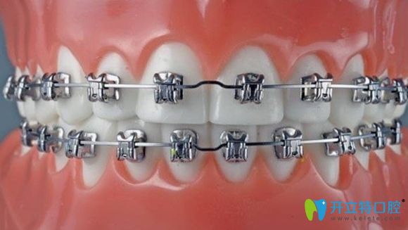 從適應(yīng)范圍和經(jīng)濟(jì)方面比較，固定矯治要比隱形矯治略勝一籌