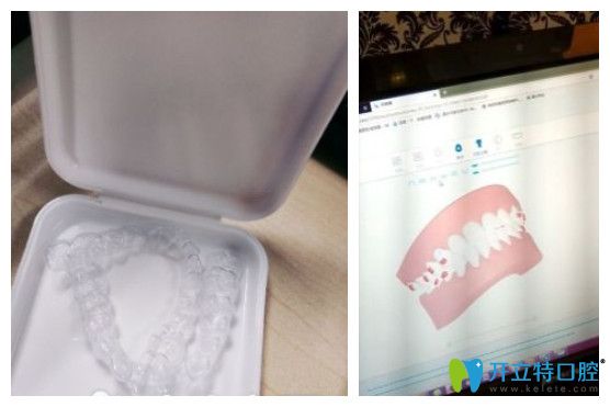 北京美萊牙齒矯正怎么樣?來(lái)自小姐姐們真實(shí)正畸感受分享