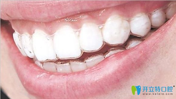 隱形矯正和固定矯正哪個(gè)好呢