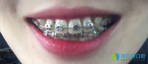 帶上金屬牙套的照片