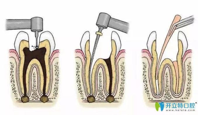 戴牙冠為什么還要磨小牙齒呢