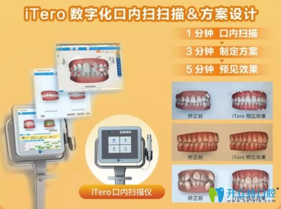 什么是iTero口掃儀 