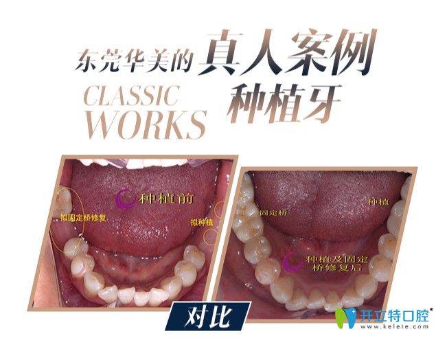 多顆牙缺失顧客在華美口腔做的種植牙案例