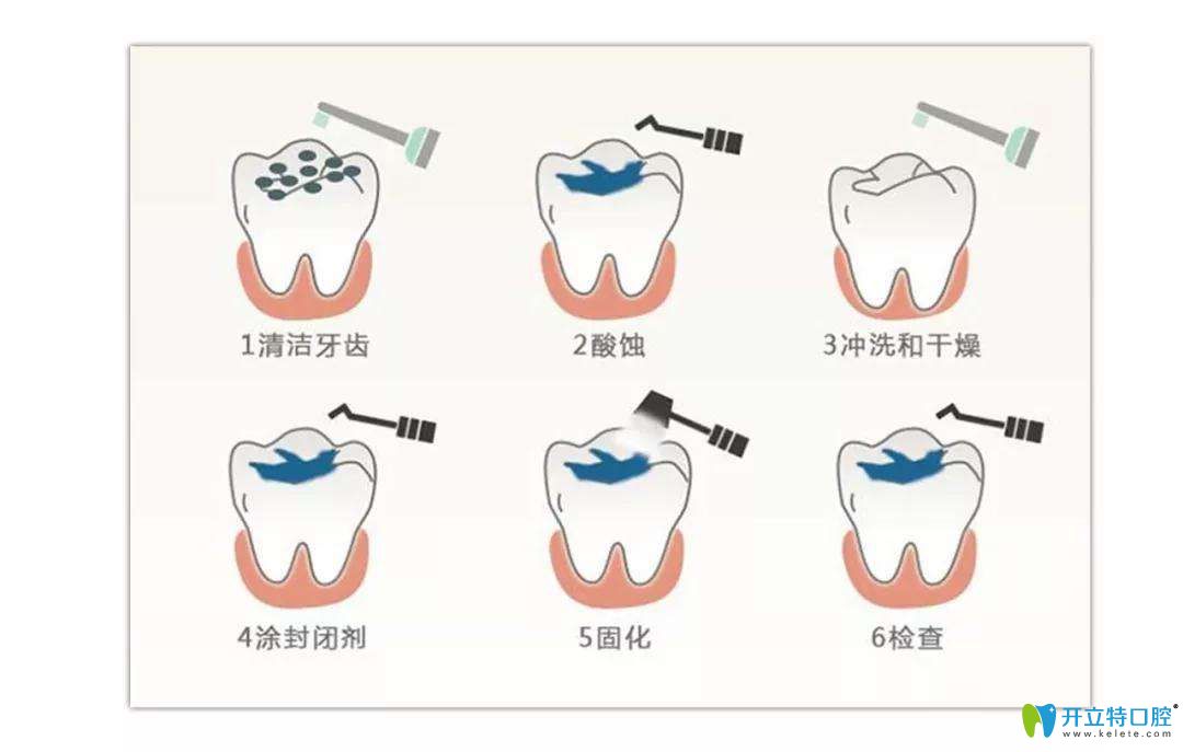 窩溝封閉步驟圖示