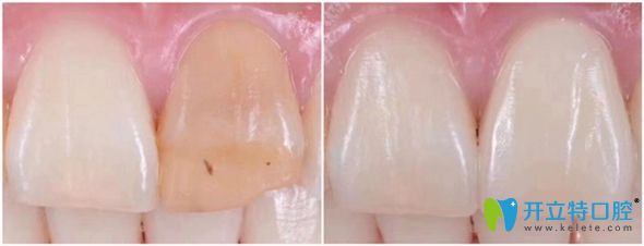 北京佳美口腔超薄牙貼面修復(fù)效果