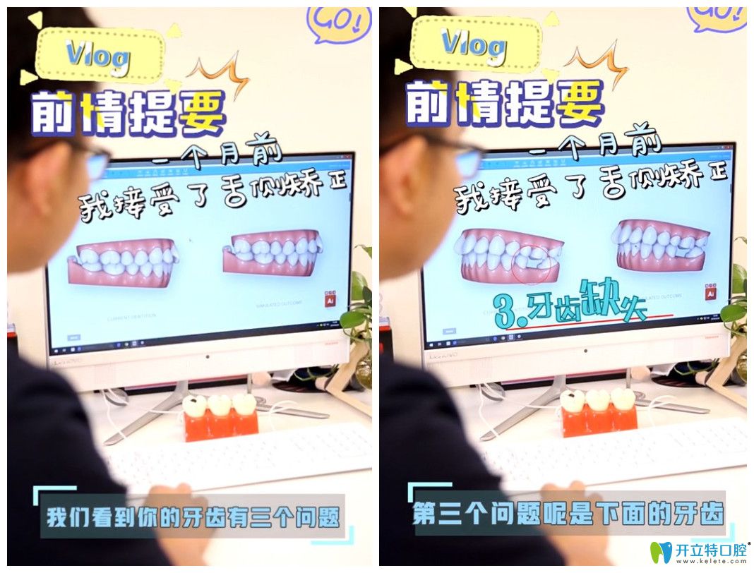 來看找上海維樂口腔楊國平做舌側矯正的人是怎么評價他的