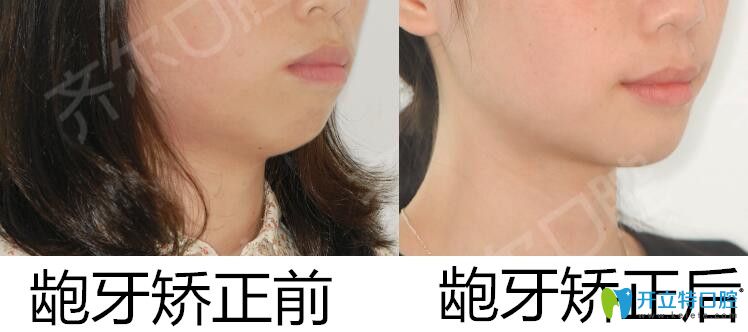 杭州齊爾口腔齙牙矯正案例