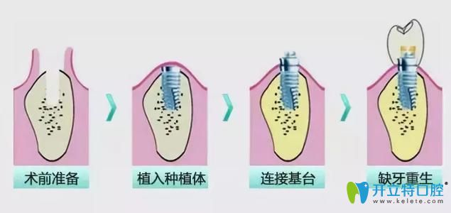 傳統(tǒng)種植牙過(guò)程 傳統(tǒng)種植牙過(guò)程