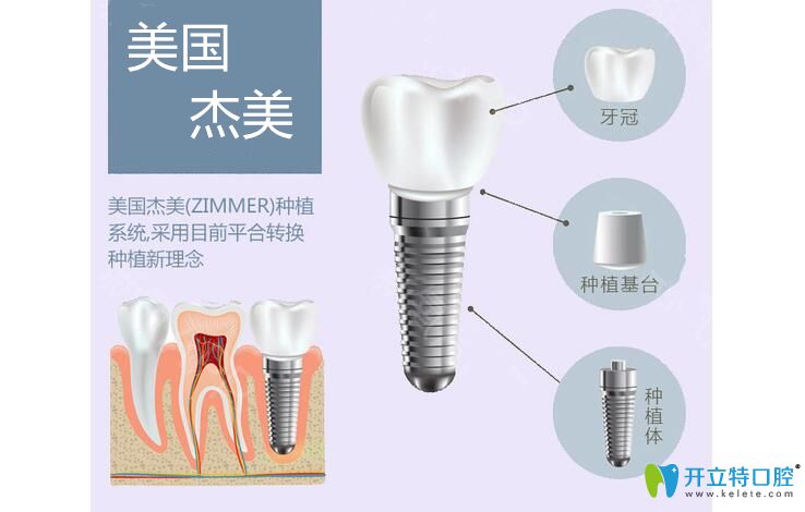 美國(guó)杰美種植體怎么樣以及zimmer種植牙價(jià)格，讓你5分鐘悉知