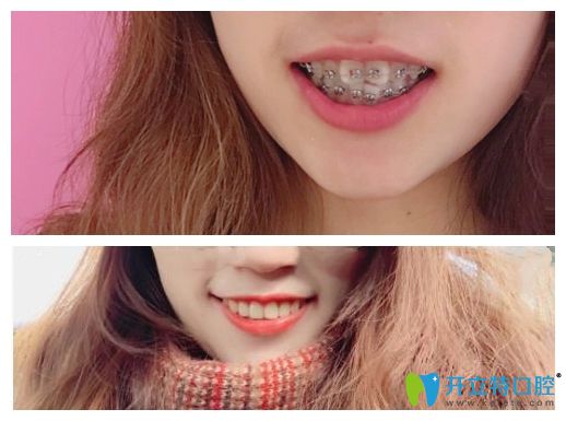 在曙光口腔牙齒矯正前后對比圖