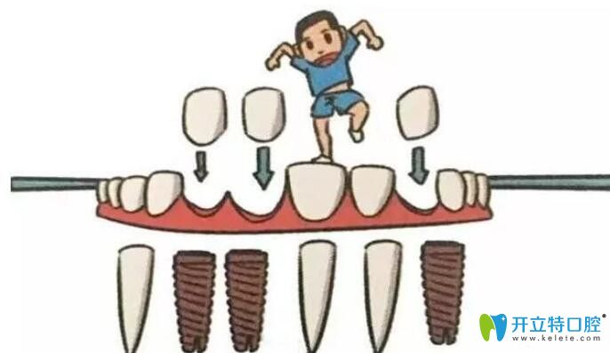 種植體形狀螺紋設(shè)計(jì)