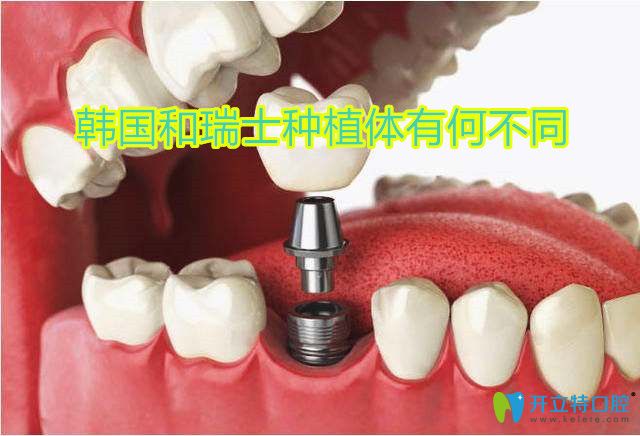 韓國(guó)和瑞士種植體有何不同,想要種牙更快一些看看它們區(qū)別