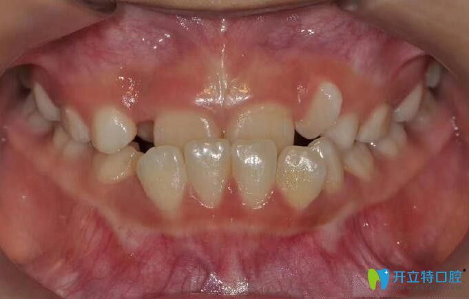 地包天牙齒在重慶茁悅口腔矯正前 地包天牙齒在重慶茁悅口腔矯正前