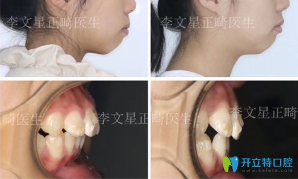 成都茁悅口腔李文星做兒童牙齒矯正案例