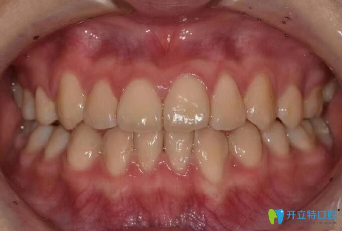 地包天在重慶茁悅口腔做隱適美牙齒矯正后 地包天在重慶茁悅口腔做隱適美牙齒矯正后