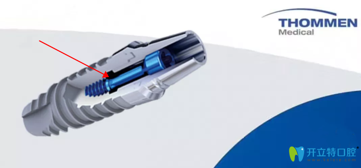 拓美種植體圖片