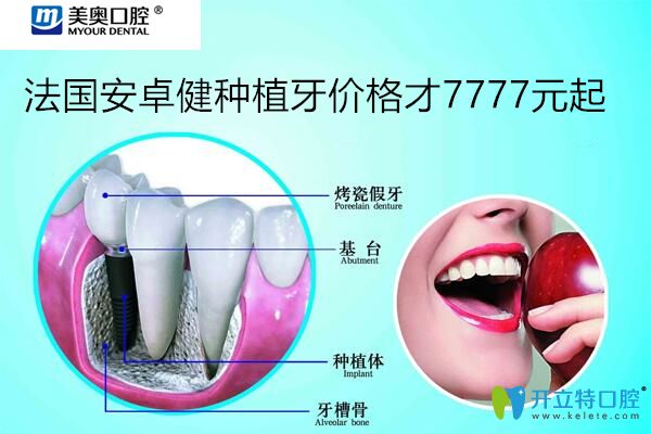 忒狠！聽說上海美奧口腔法國安卓健種植牙價(jià)格7777元起