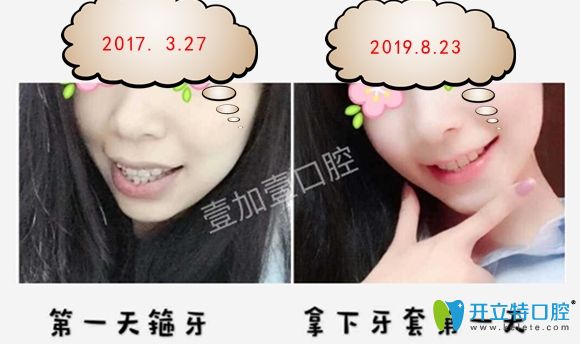 在壹加壹口腔做陶瓷半隱形矯正一年五個月效果圖