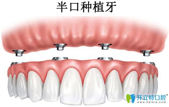 想告訴你在大連康美諾口腔做韓系半口種植牙價(jià)格僅5萬(wàn)元起