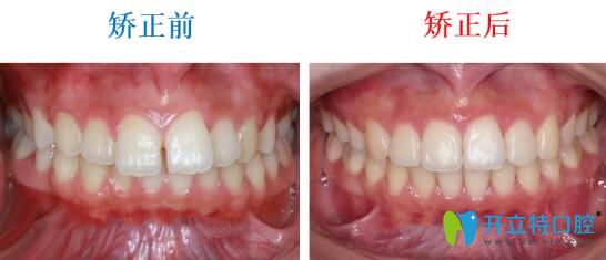 在武漢壹加壹口腔做齙牙矯正前后對比照 在武漢壹加壹口腔做齙牙矯正前后對比照