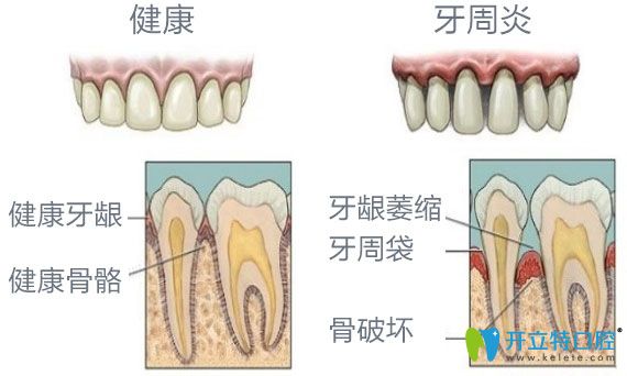 健康牙齒與牙槽骨萎縮牙齒之間對(duì)比圖