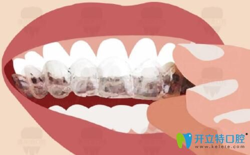 武漢壹加壹口腔隱適美牙齒矯正 武漢壹加壹口腔隱適美牙齒矯正