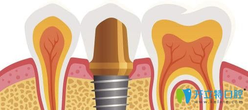 缺牙影響臉型，顯老