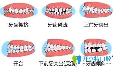 需要做矯正的幾種情況 需要做矯正的幾種情況