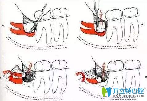 拔牙過(guò)程 拔牙過(guò)程