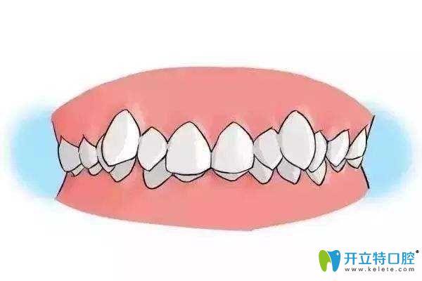 牙列不齊 牙列不齊