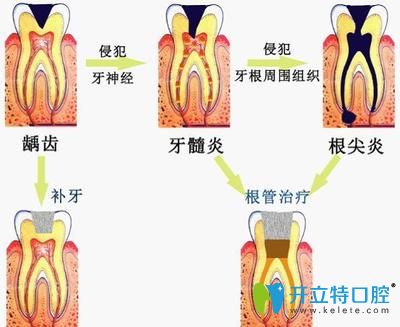根尖周炎的形成 根尖周炎的形成