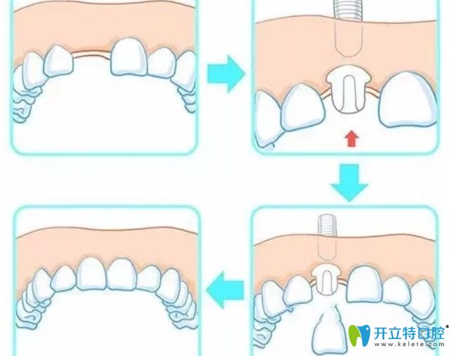 為啥這么多人選擇即刻種植牙 為啥這么多人選擇即刻種植牙