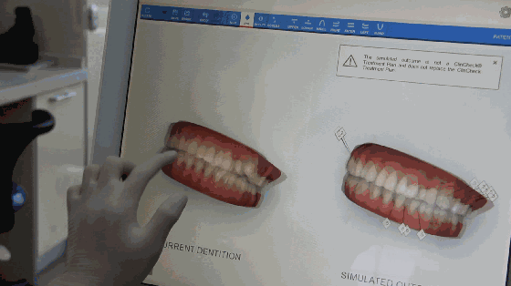 正畸黑科技——ITERO口掃圖